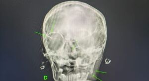 Mulher sofre ferimentos graves após ser agredida pelo filho