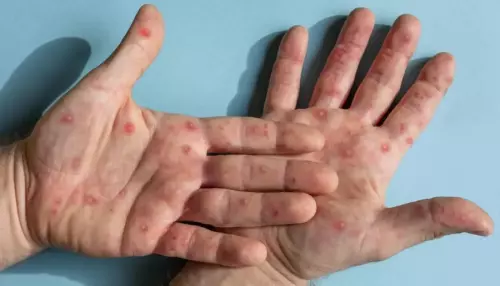 Mais uma cidade da região confirma caso de Mpox