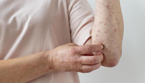 Casos de Mpox chegam a 140 no Brasil em 2026 e especialistas reforçam atenção aos sintomas