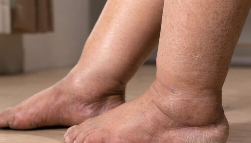 Inchaço nas pernas pode ser lipedema ou linfedema: saiba como identificar