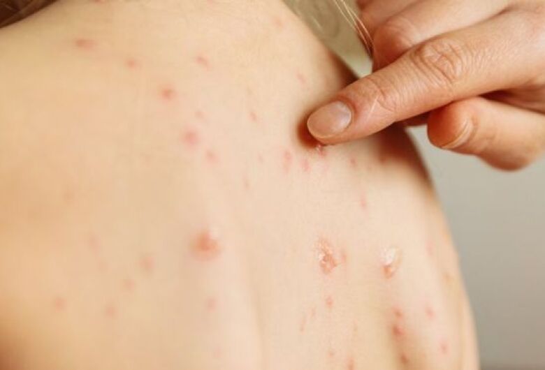 Estado de SP confirma caso importado de sarampo