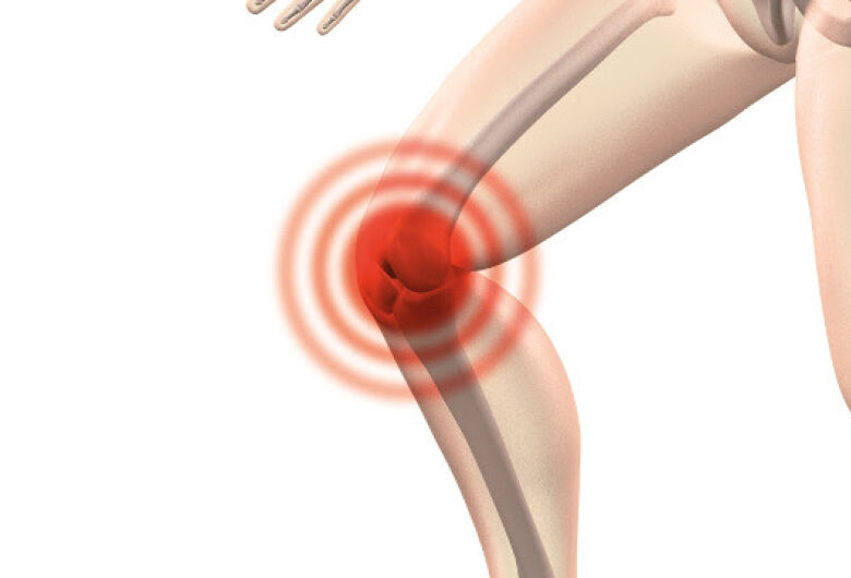 Osteoartrite do joelho é tema de pesquisa da UFSCar
