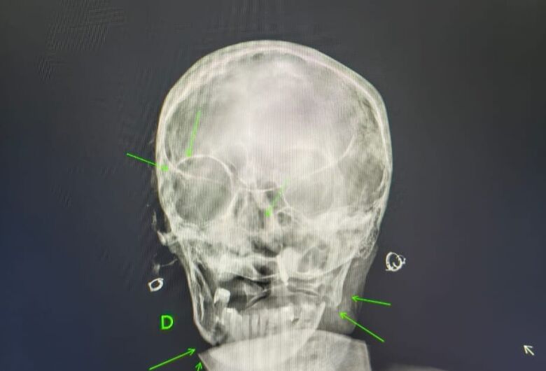 Mulher sofre ferimentos graves após ser agredida pelo filho