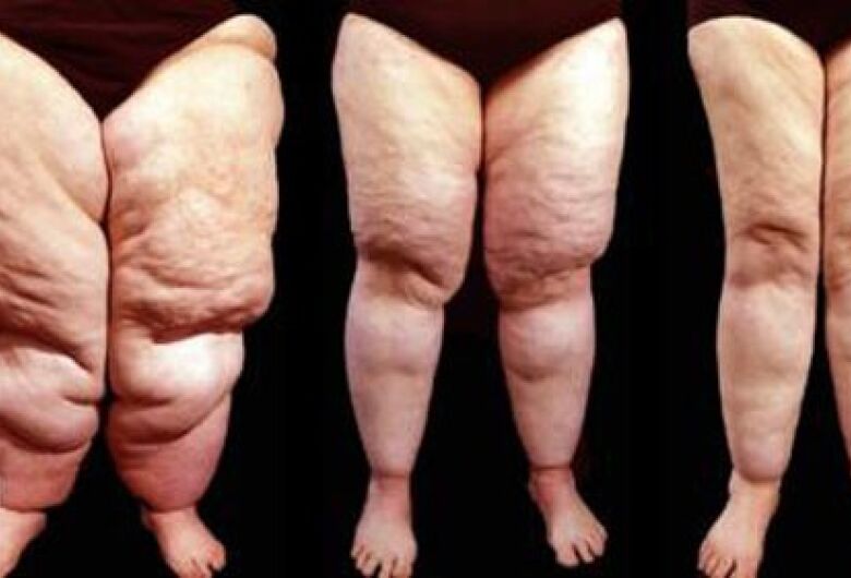 Pesquisadores da USP São Carlos abrem segunda chamada para tratamento experimental de lipedema