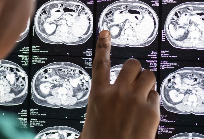 Epilepsia além da convulsão: Condição que afeta milhões de pessoas pode se manifestar de formas sutis