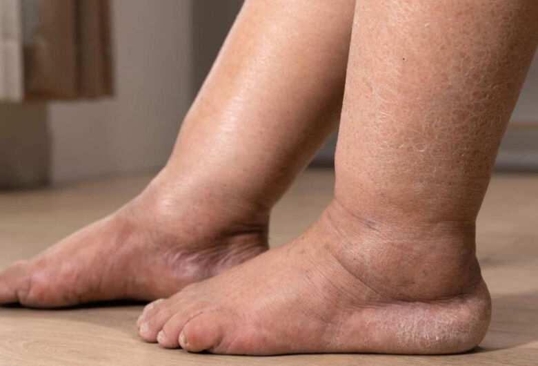 Inchaço nas pernas pode ser lipedema ou linfedema: saiba como identificar