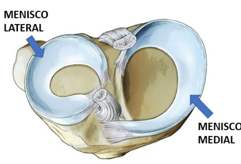 Разрыв медиального и латерального мениска