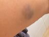 Hematomas no braço da mulher