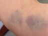 Hematomas no braço da mulher
