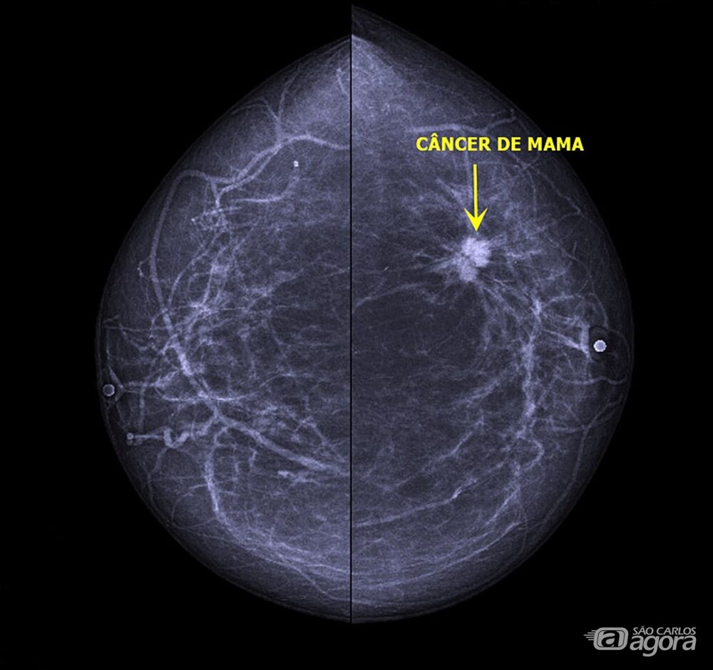 Mamografia Cancer De Mama