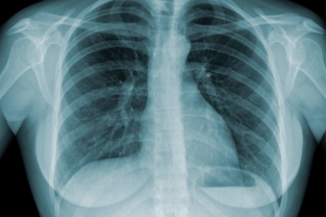 Pulmão tuberculose - Crédito: divulgação