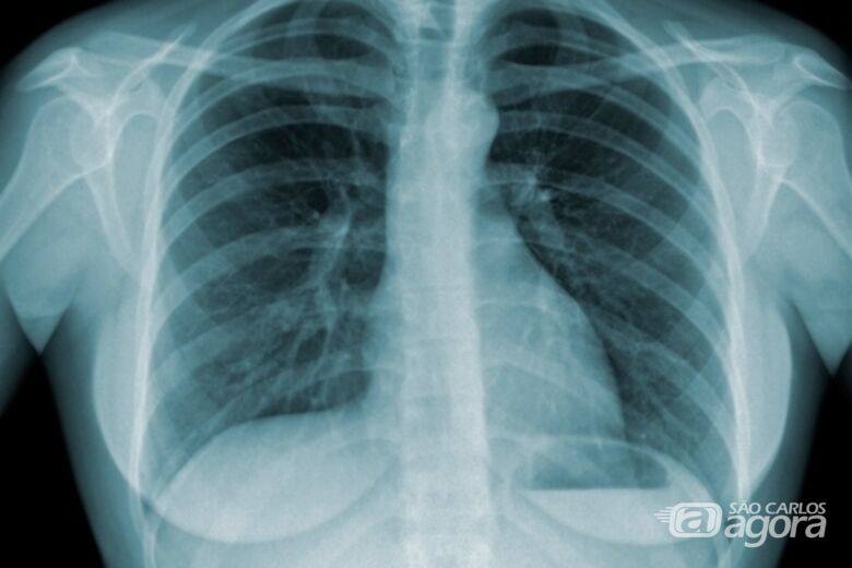 Pulmão tuberculose - Crédito: divulgação