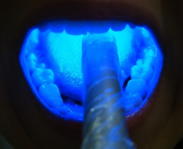 Descontaminação da boca de pacientes para evitar progressão de infecção, ou no preparo do paciente antes de procedimentos odontológicos e médicos, a fim de evitar contaminação dos próprios profissionais. - Crédito: divulgação