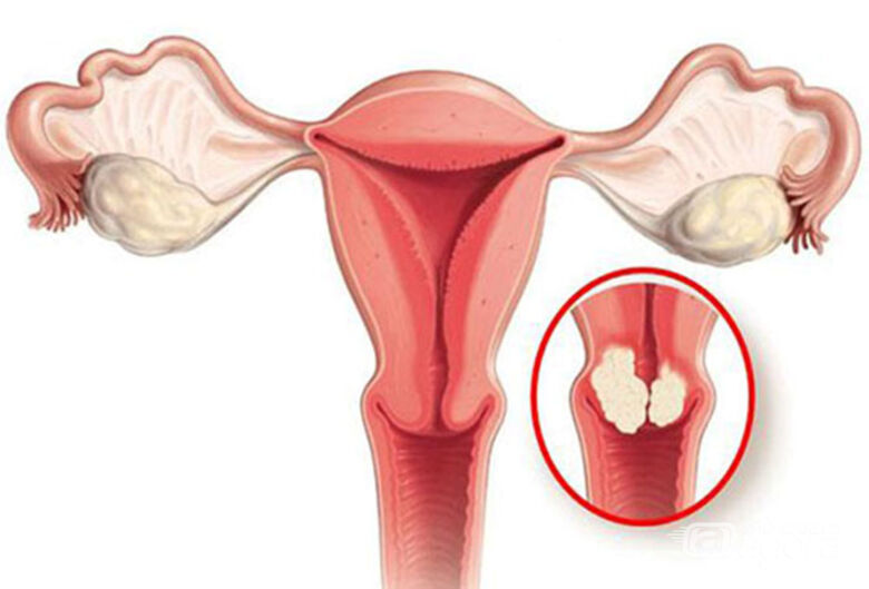 IFSC convoca mulheres para tratamento de lesões causadas pelo vírus HPV (condilomas/verrugas) - Crédito: divulgação