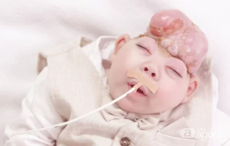 Após decisão judicial, menino com má formação no crânio é transferido para Porto Alegre - Crédito: arquivo pessoal