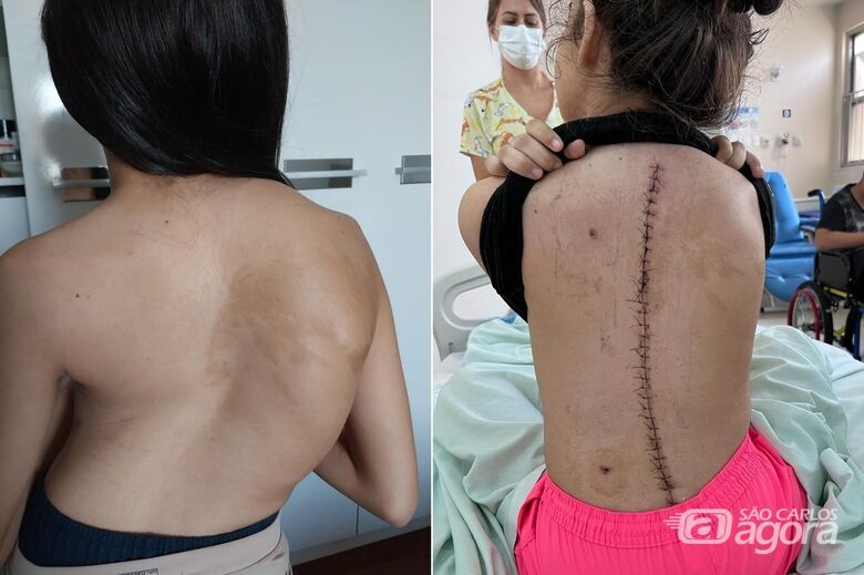 Santa Casa realiza cirurgia de escoliose neuromonitorizada pela primeira vez pelo SUS - Crédito: Comunicação Santa Casa