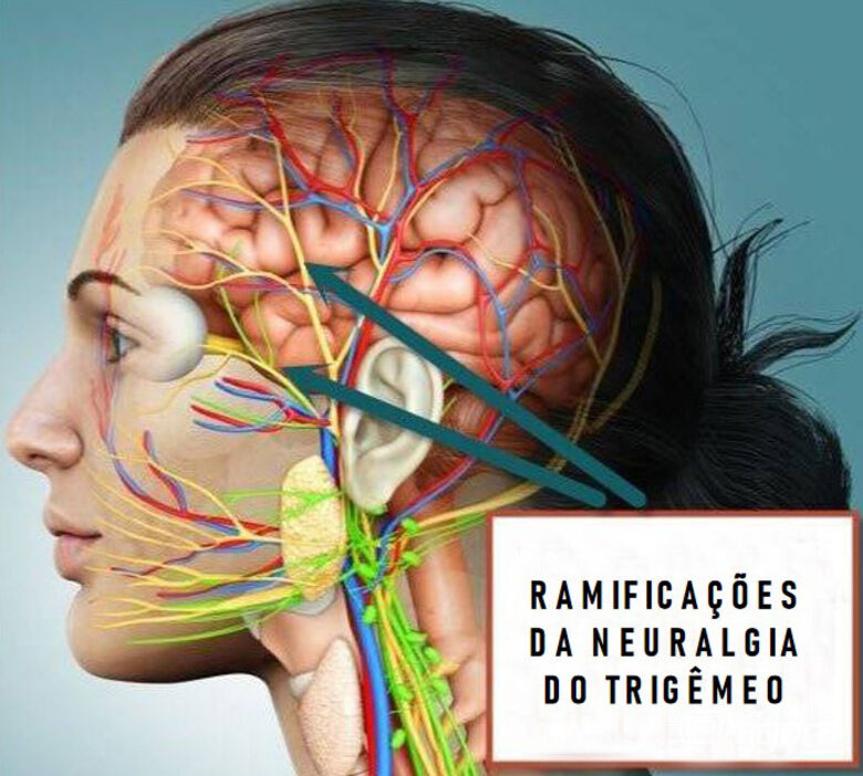 A neuralgia do trigêmeo pode se desenvolver a partir de causas idiopáticas - Crédito: Jacksonville Orthopaedic Institute