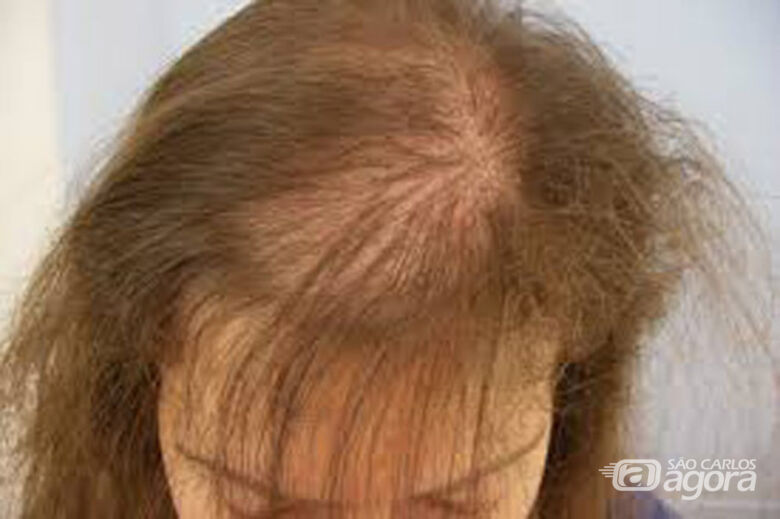 USP São Carlos chama mulheres para tratamento de alopecia androgenética - Crédito: Divulgação