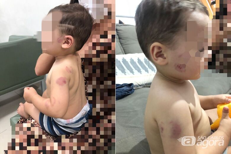 Bebê volta para casa com várias mordidas e pais denunciam escola de São Carlos - Crédito: arquivo pessoal