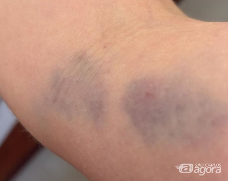 Hematomas no braço da mulher - Crédito: arquivo pessoal