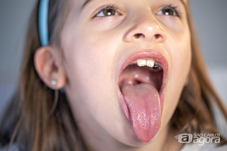 Criança exibe a boca - Crédito: Freepik