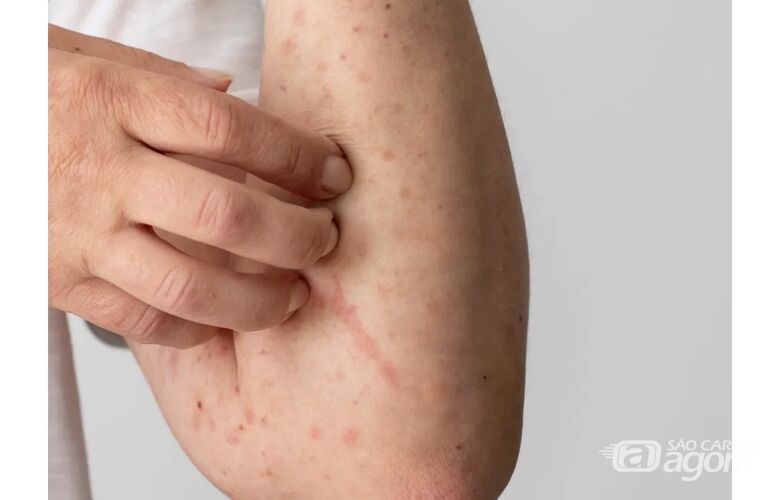 Escarlatina  - Crédito: Freelik