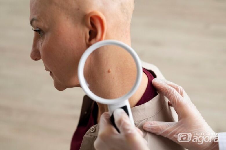 Diagnósticos de câncer de pele crescem mais de 1.500% em dez anos e escancaram desigualdade no acesso ao tratamento - Crédito: Freepik