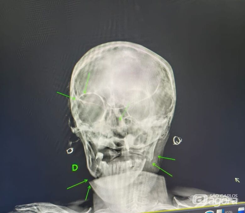 Imagem de raio-x mostra fraturas sofridas pela mulher - Crédito: SCA