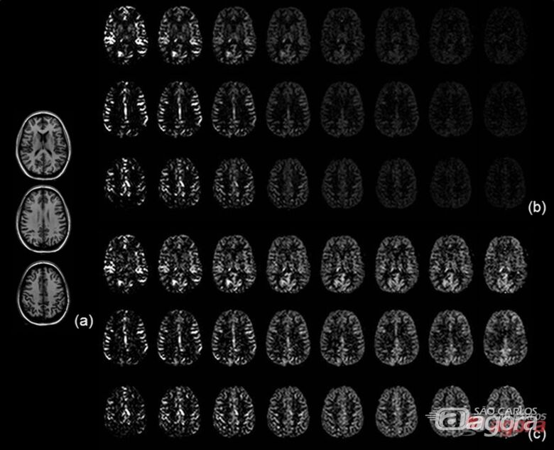 Esses promissores resultados foram obtidos através de imagens por Ressonância Magnética em indivíduos sem doenças cerebrovasculares - 