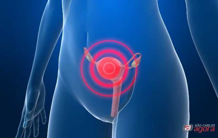 Câncer de colo do útero é uma doença que se desenvolve a partir da Neoplasia Intraepitelial Cervical. Foto: Divulgação -