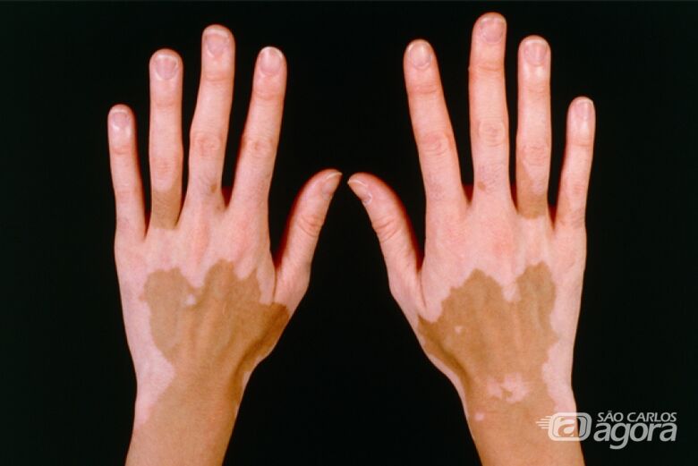 Laboratório da UFSCar convida mulheres portadoras de vitiligo a participarem de pesquisa sobre saúde e bem-estar - Crédito: Divulgação