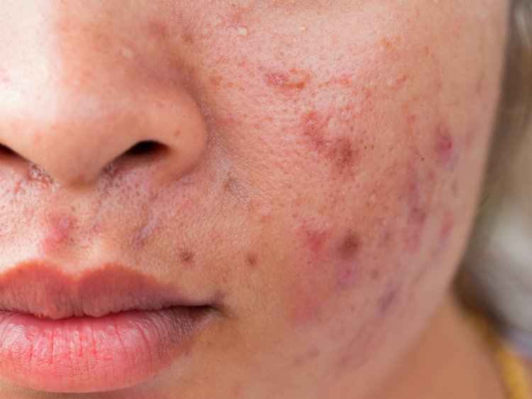IFSC/USP recruta voluntários para pesquisa de tratamento da acne - Crédito: Divulgação