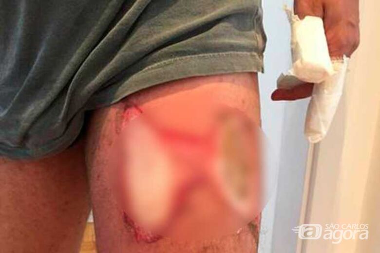 Homem tem queimaduras na perna e mão após celular explodir no bolso da calça - Crédito: Divulgação
