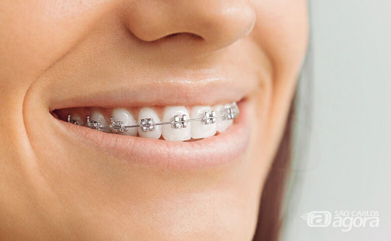 Ortodontia UFSCar seleciona pacientes que necessitam de aparelhos nos dentes - Crédito: Divulgação