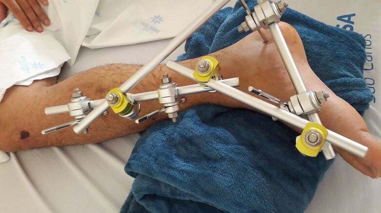 Motociclista que fraturou a perna passará por cirurgia semana que vem - Crédito: Divulgação