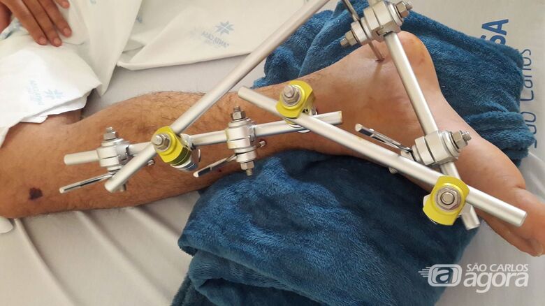 Motociclista que fraturou a perna passará por cirurgia semana que vem - Crédito: Divulgação