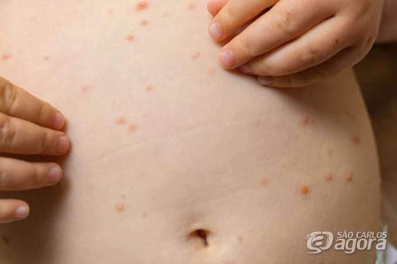 Vacina é a única forma de prevenção contra o sarampo -