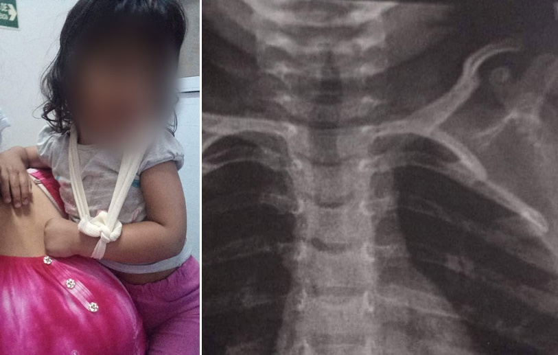 Menina autista de 2 anos quebra a clavícula em creche municipal de